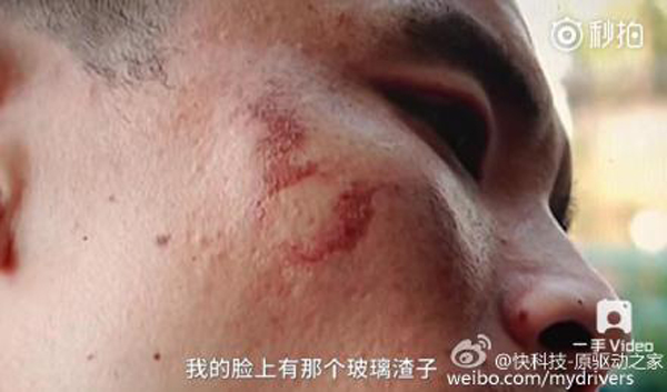 男子手部和臉部不同程度被炸傷。